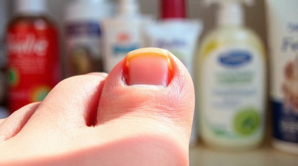 Les meilleurs traitements pour l'infiltration de l'ongle et leurs causes